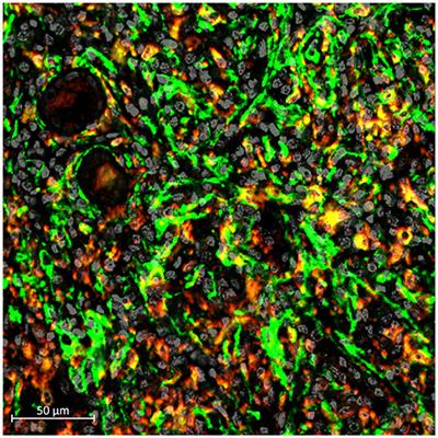 Editorial: Immune Landscape of Kidney Pathology